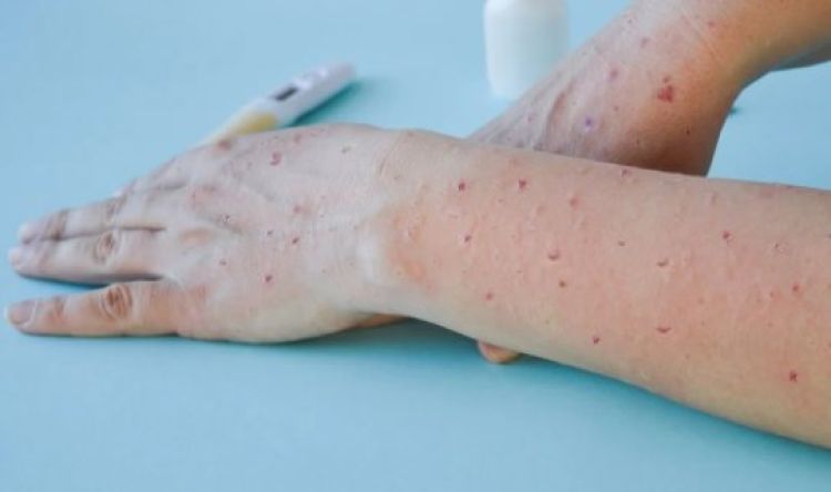 Ministro diz que Brasil terá antiviral para tratar varíola dos macacos - Foto: Reprodução