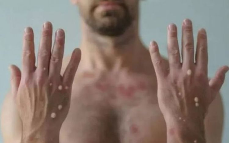 Primeiro caso de varíola dos macacos é confirmado no Norte do Piauí 